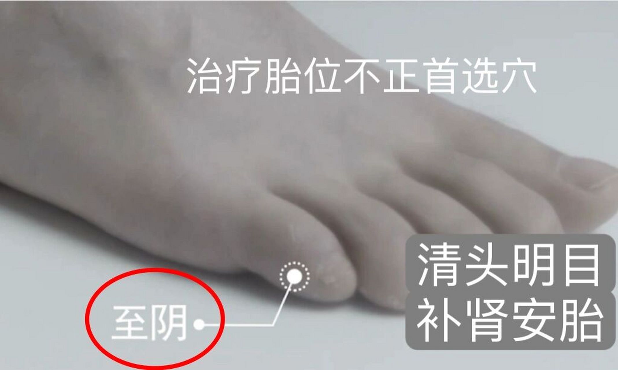 一天记一个穴位—至阴 至阴穴,属足太阳膀胱经,井穴.