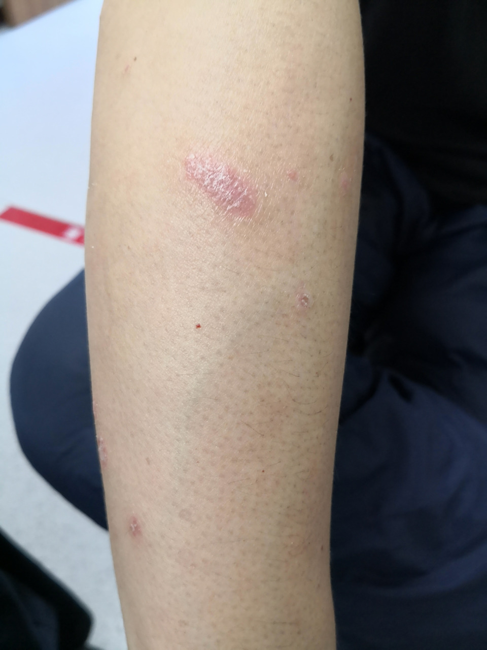 银屑病患者的双小腿伸侧症状.