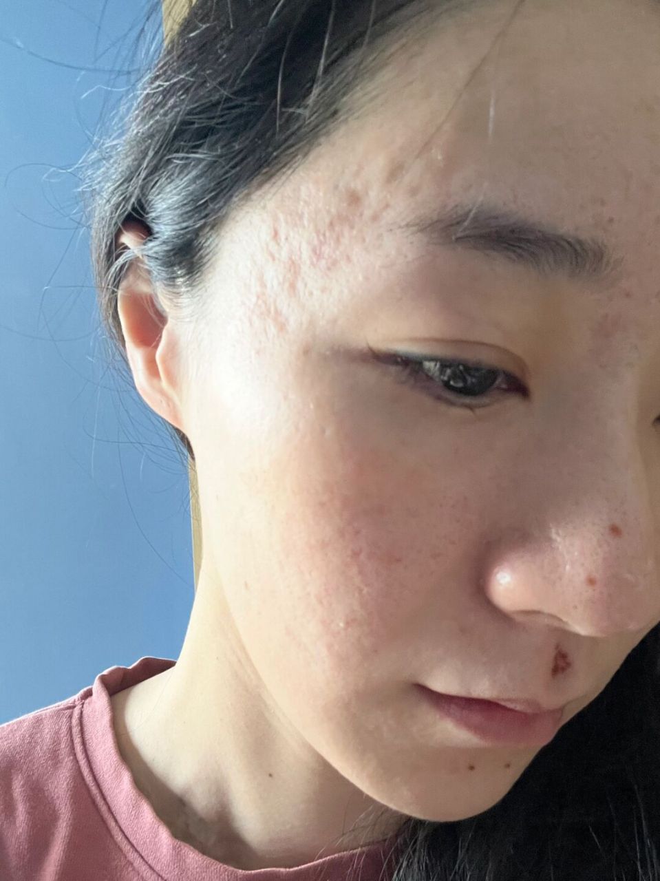 韩国痘坑技术究竟有用吗?