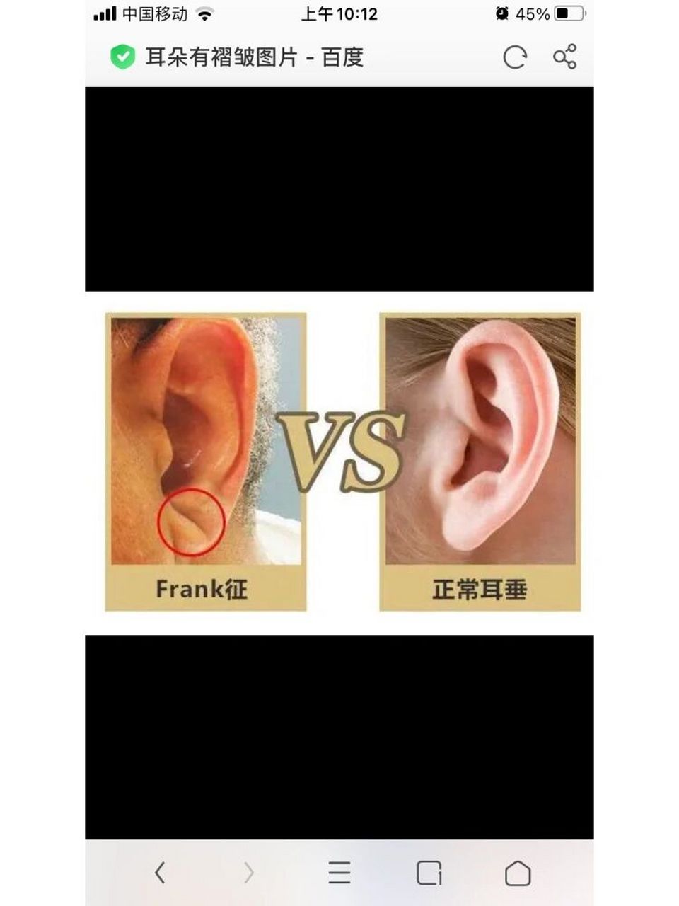 耳垂有褶皱小心心脏病 耳由心生,从耳朵上是能看出心脑血管疾病的.
