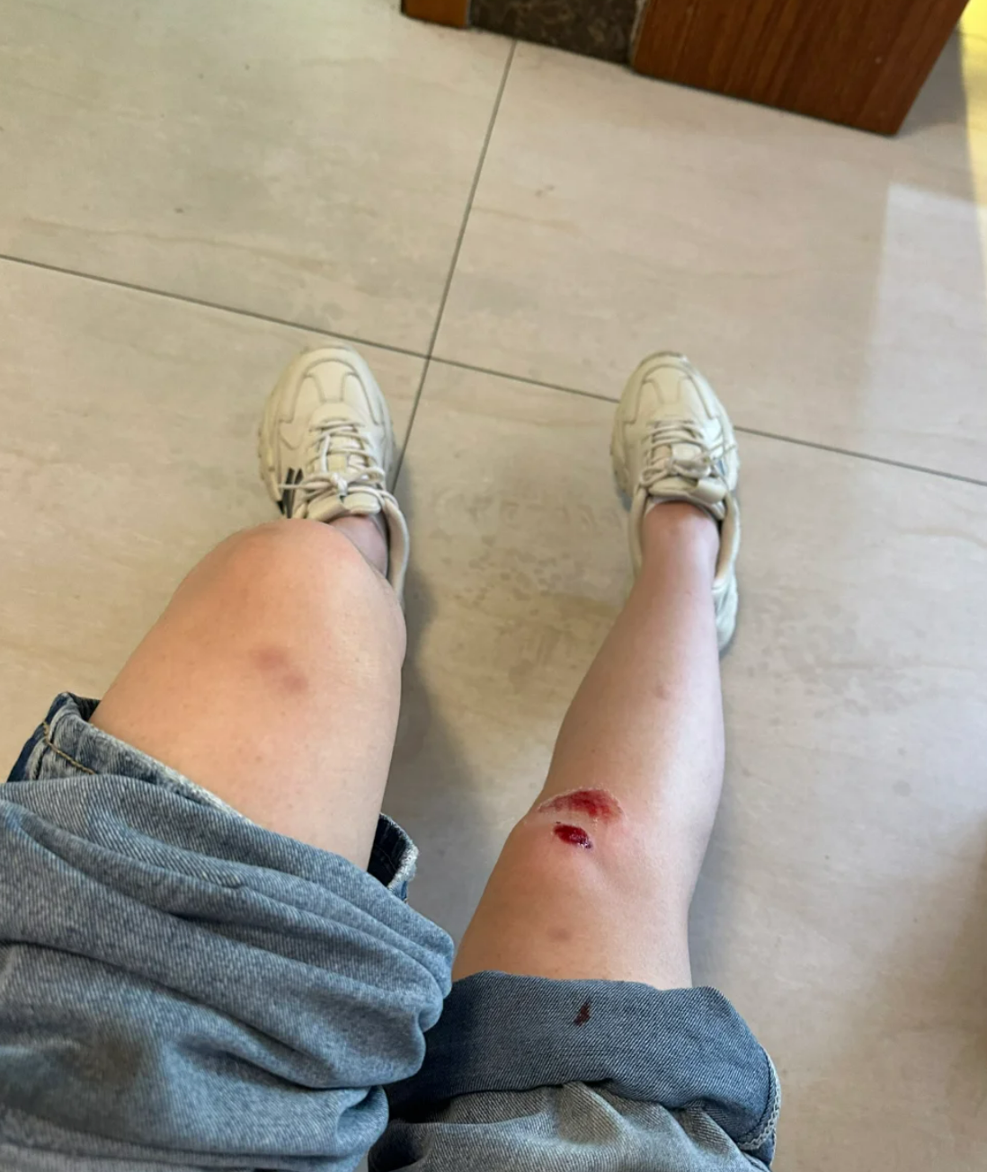 腿摔伤了几天后一站就坠胀痛的原因