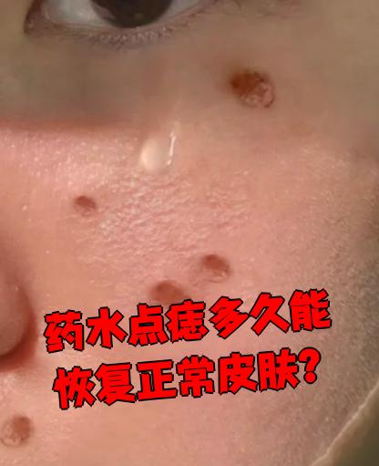 药水点痣后皮肤完全恢复通常需要半个月到一个月,具体时间要看个人