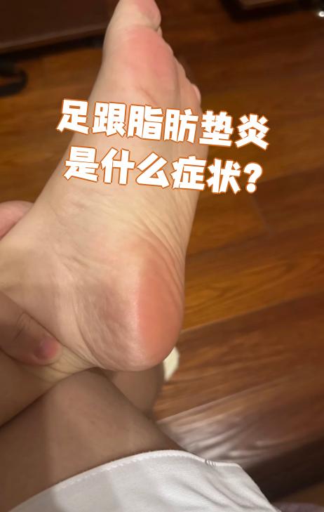 足跟脂肪垫炎(也叫跖筋膜炎)最典型的症状就是足跟疼痛