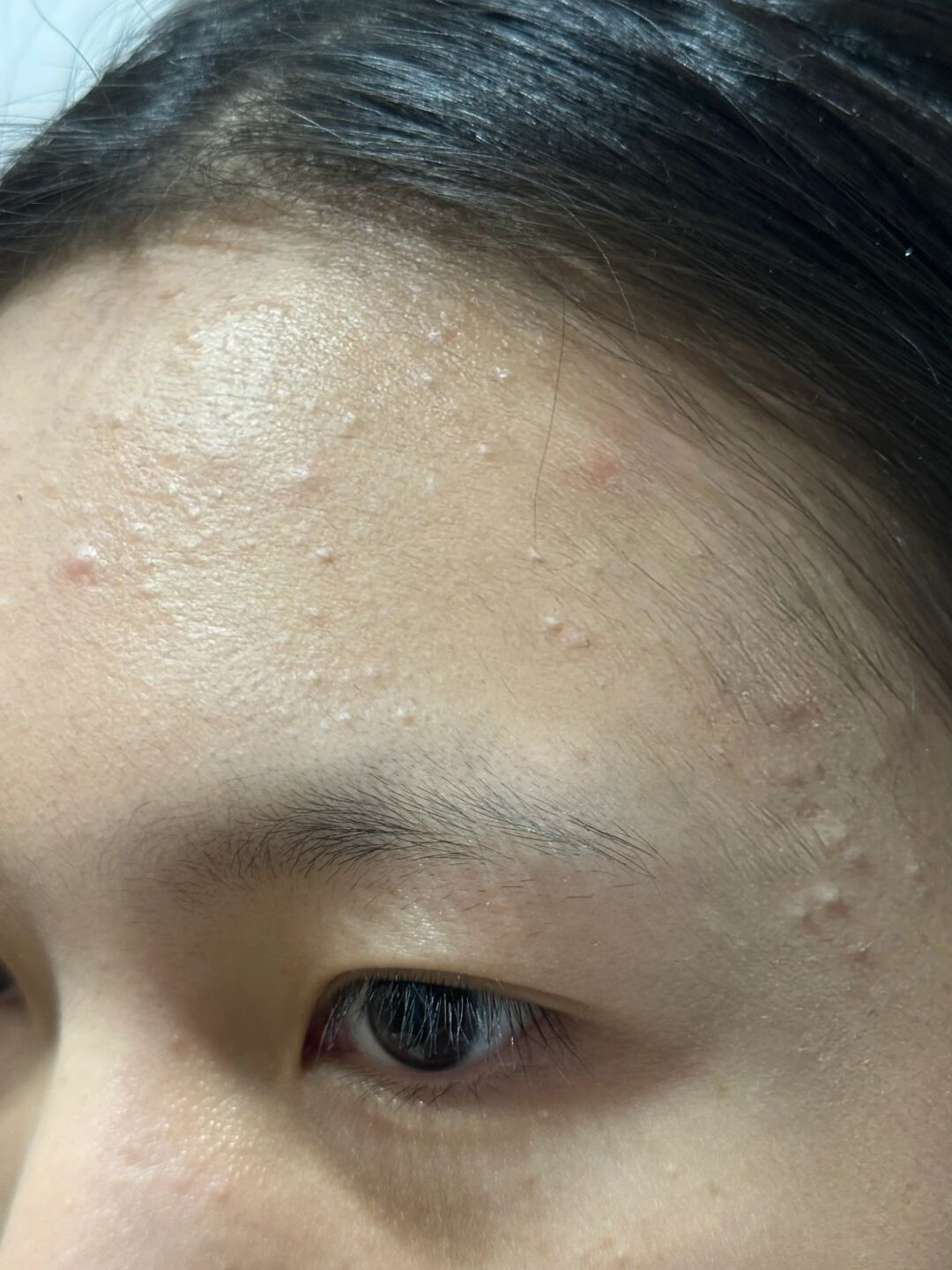 闭口会慢慢自己消失吗额头闭口粉刺额头长小疙瘩图片对照闭口是什么