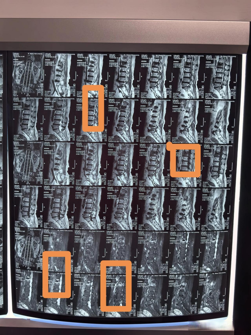 腰椎压缩性骨折 其主要症状包括腰部疼痛,活动受限等.