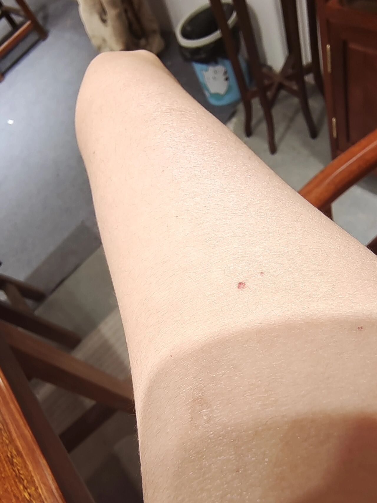 提问 手臂上很多这种小血点,皮下出血么?是什么原因造成的?