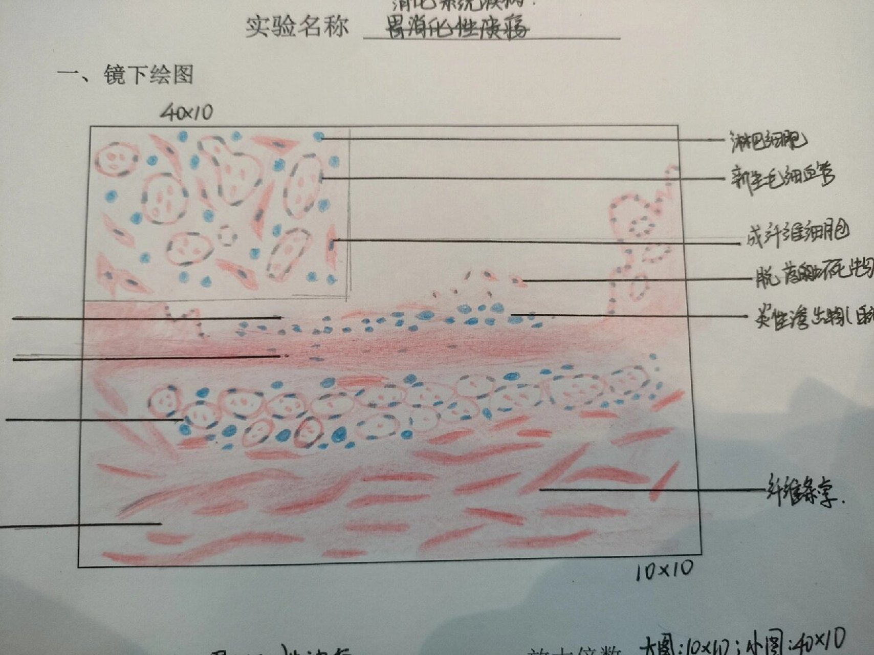 胃溃疡病理手绘图图片