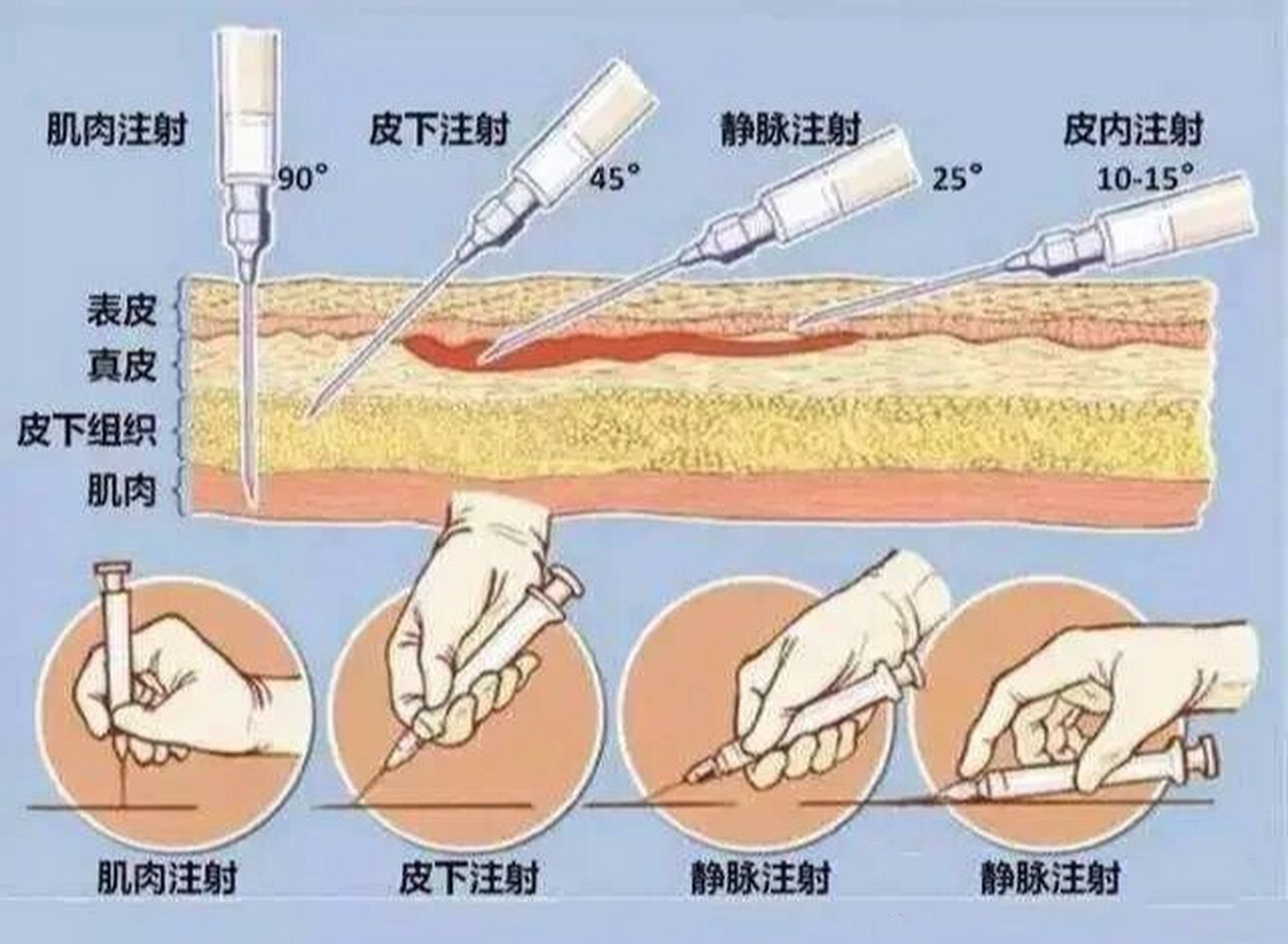 血气进针角度图片图片