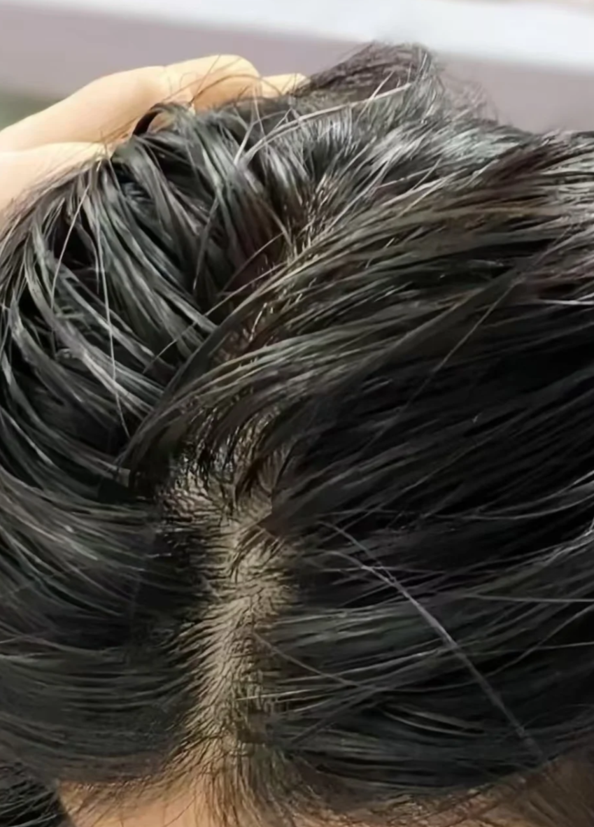 头发出油严重有几个常见原因.首先是遗传因素