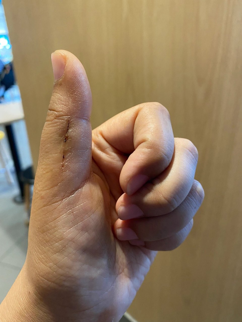 腱鞘巨细胞瘤术后第17天 腱鞘巨细胞瘤术后第17天,现在伤口及四周,指