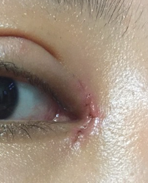 开眼角之后疤痕增生怎么办?