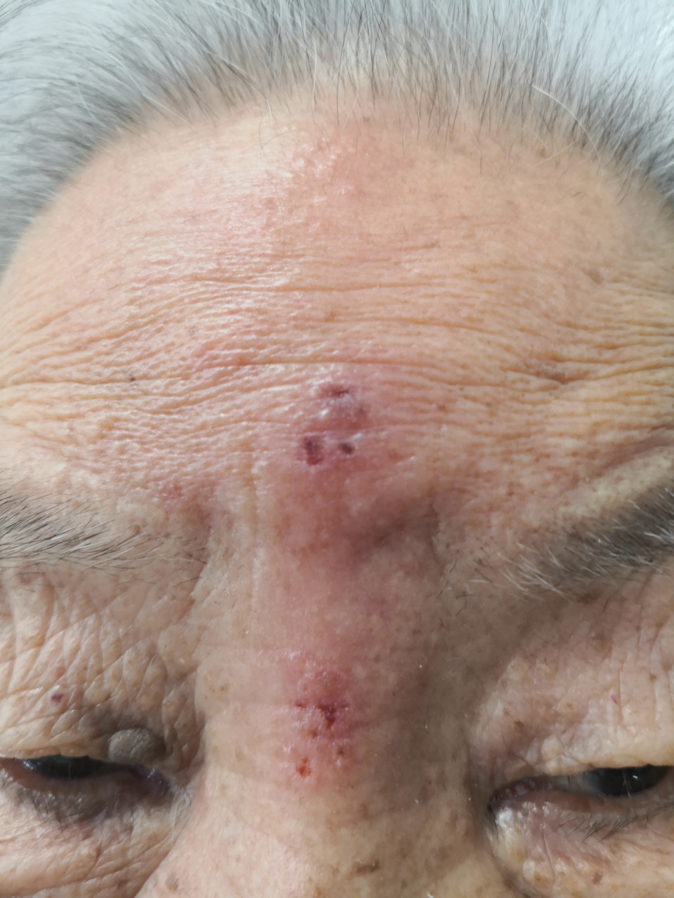 老年女性的额头带状疱疹症状.#带状疱疹##解决皮肤问题专注皮肤美容