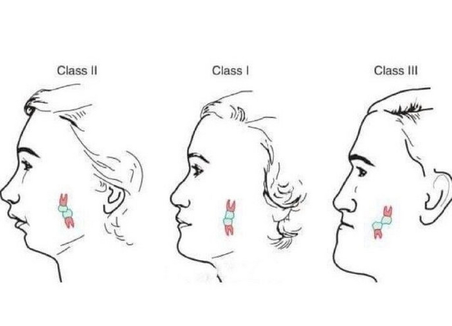 广州牙齿矫正|安氏i,ii,iii类面型 有很多正畸客人