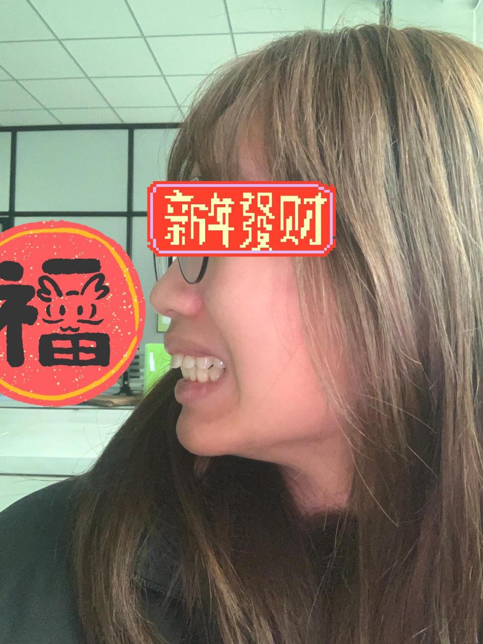 牙齿整齐但微凸,医生让拔四颗牙 高中的时候整过一次,没拔牙,没有好好