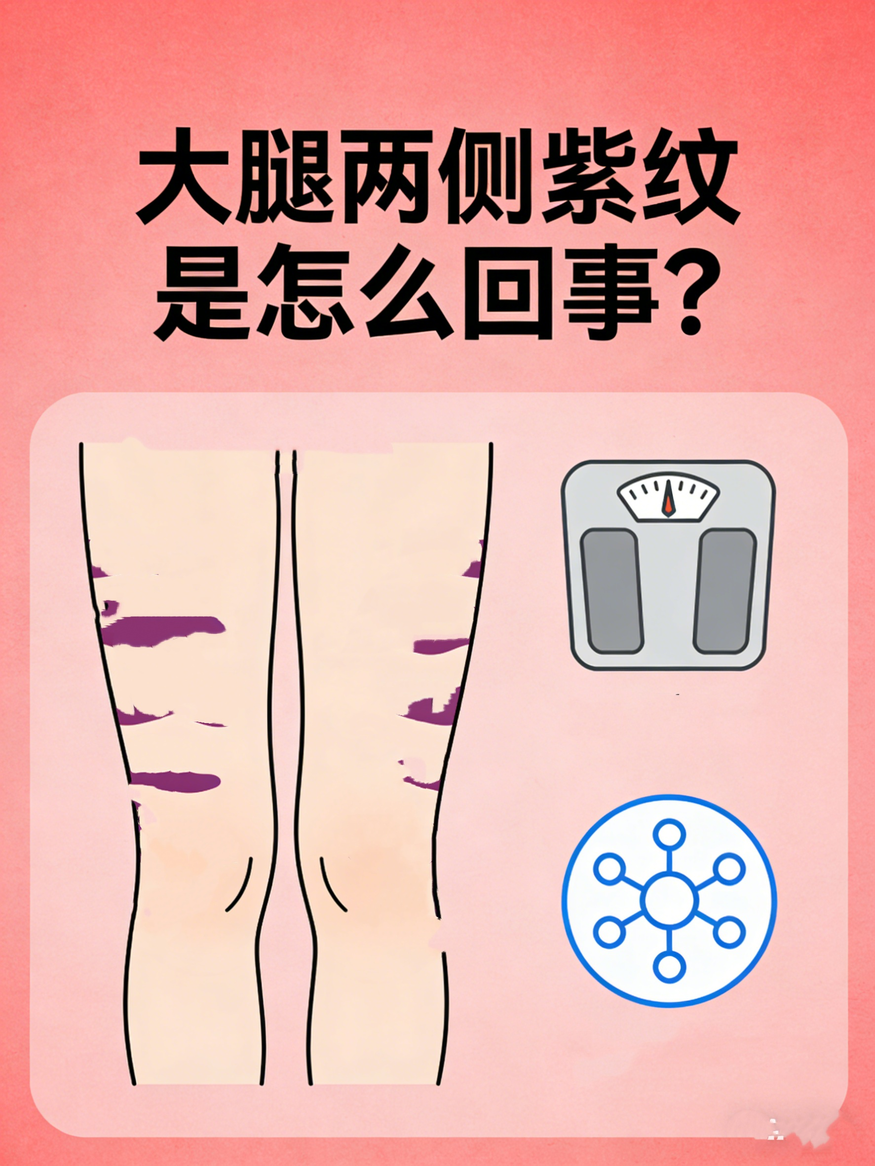 紫纹常见于体重快速增加,青春期猛长或长期使用糖皮质激素者
