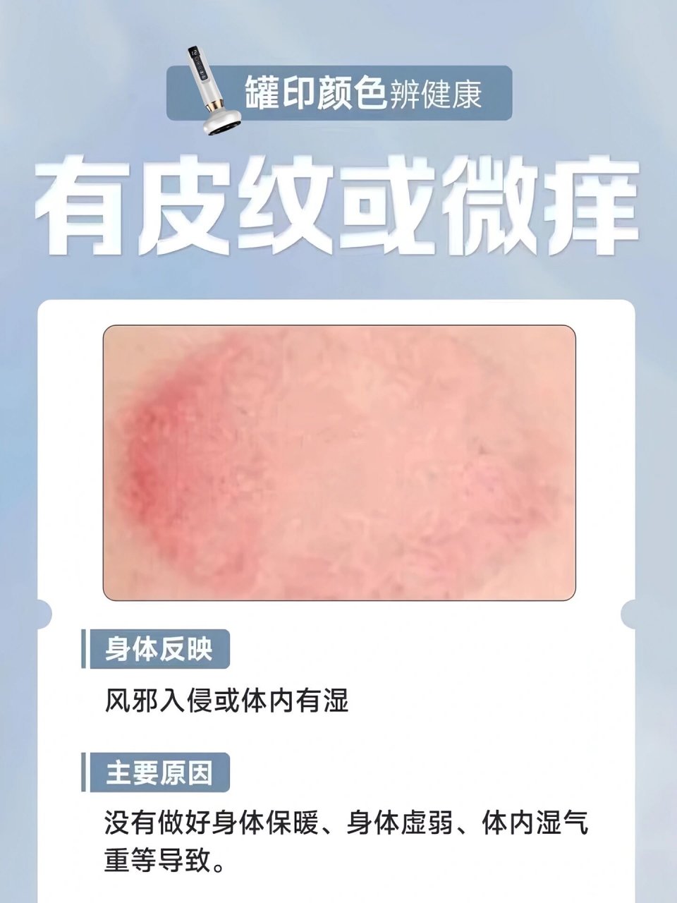 拔罐后的"罐印"有大学问,不同颜色对应不同 拔火罐后会留有罐印.