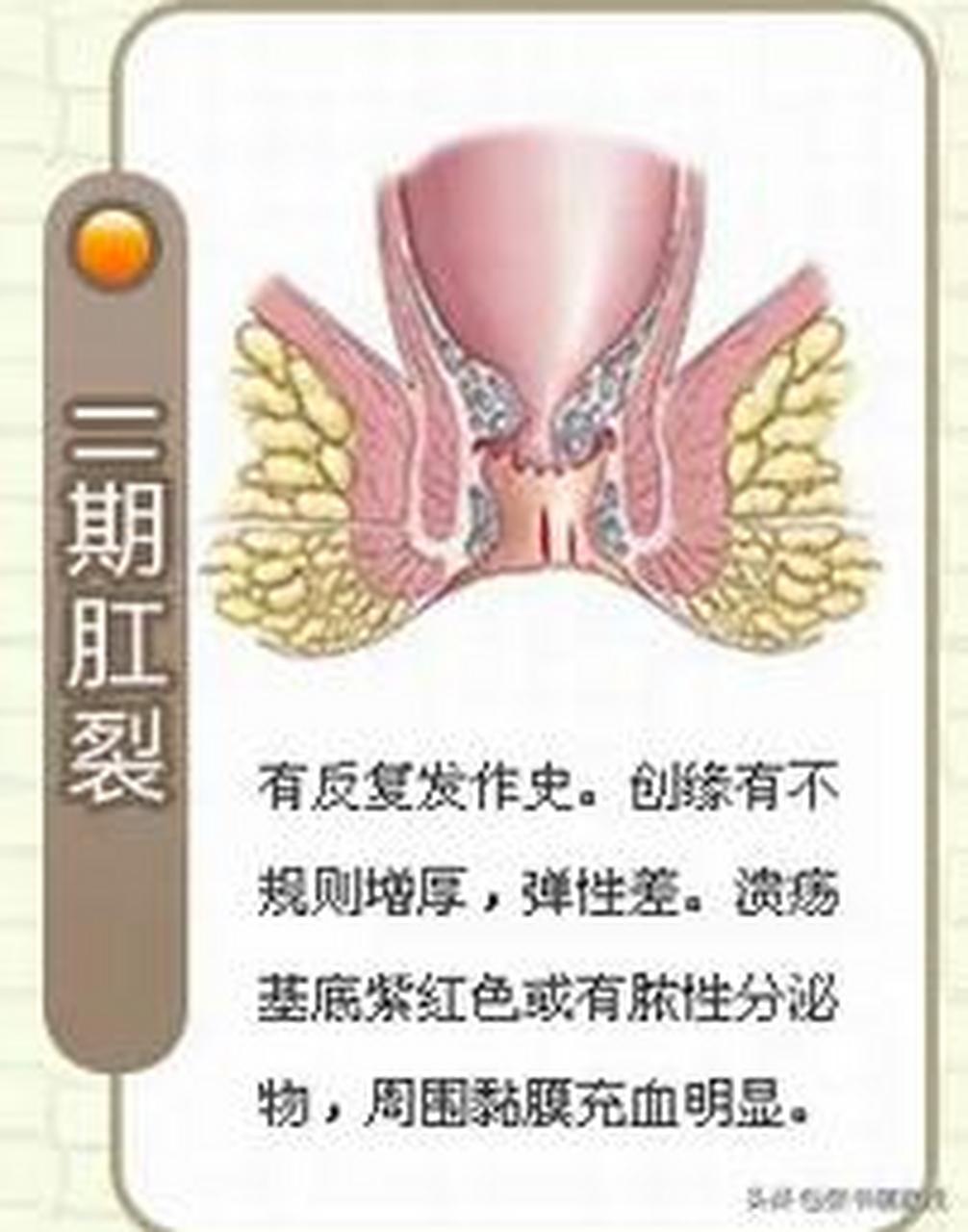 肛裂的症状正常图片