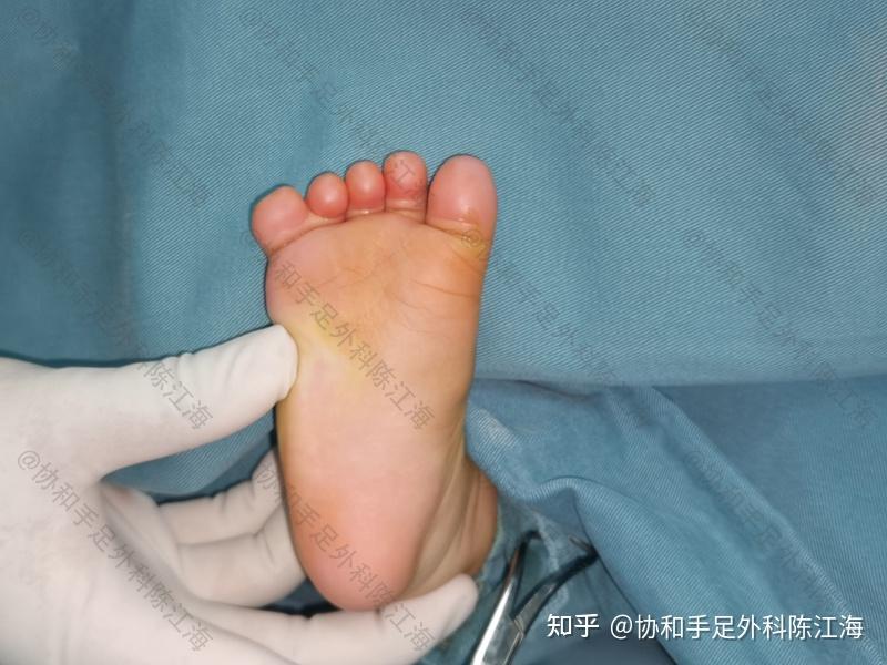 我脚趾并指已经遗传儿子了是否会继续遗传孙子