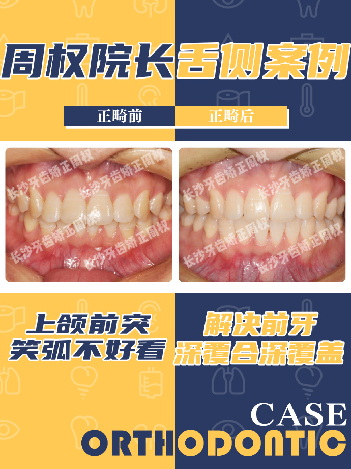 长沙牙齿矫正舌侧病例丨解决前牙深覆合深覆盖改善笑弧