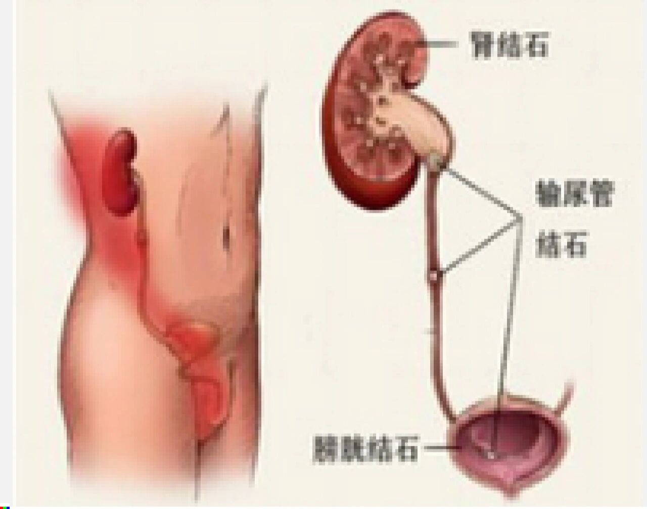 治疗肾结石选择:经皮肾镜取石术(保肾) 技术概述:经皮肾镜取石术是保