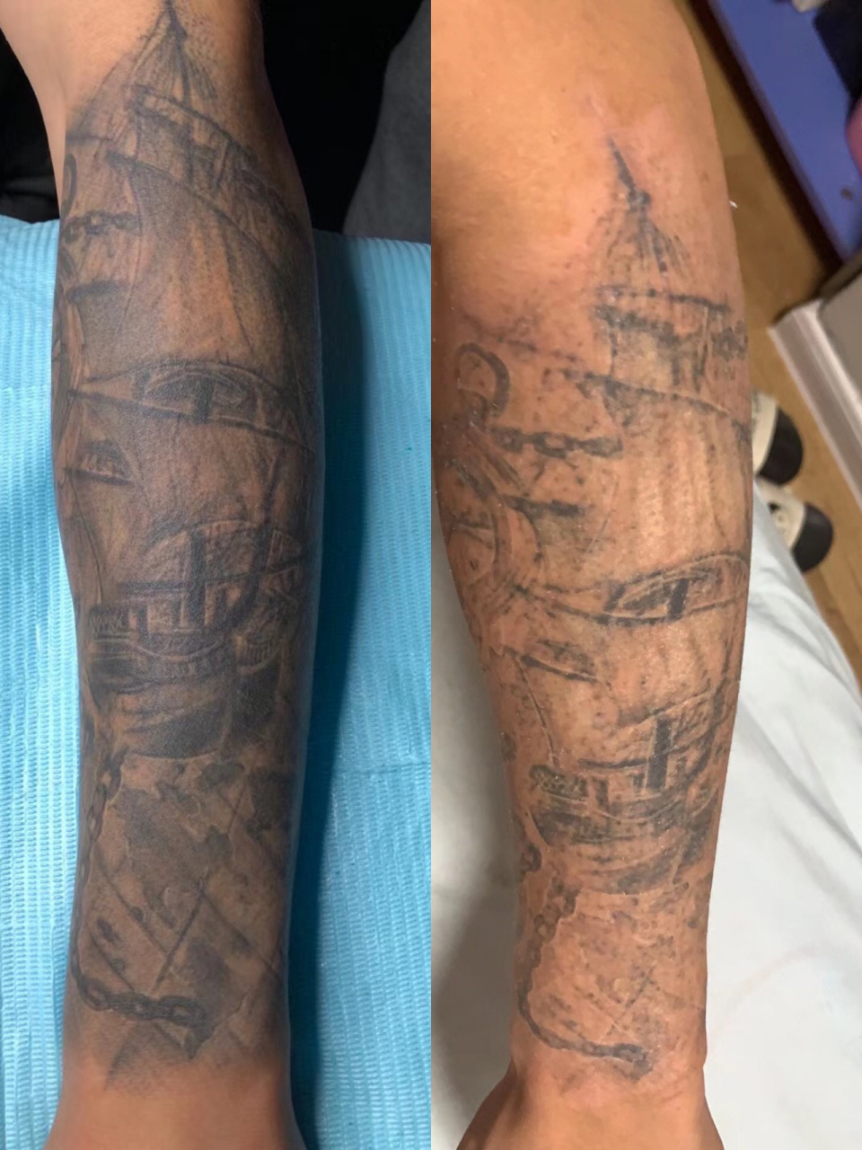 洗纹身 花臂 深圳洗纹身 花臂清洗 !