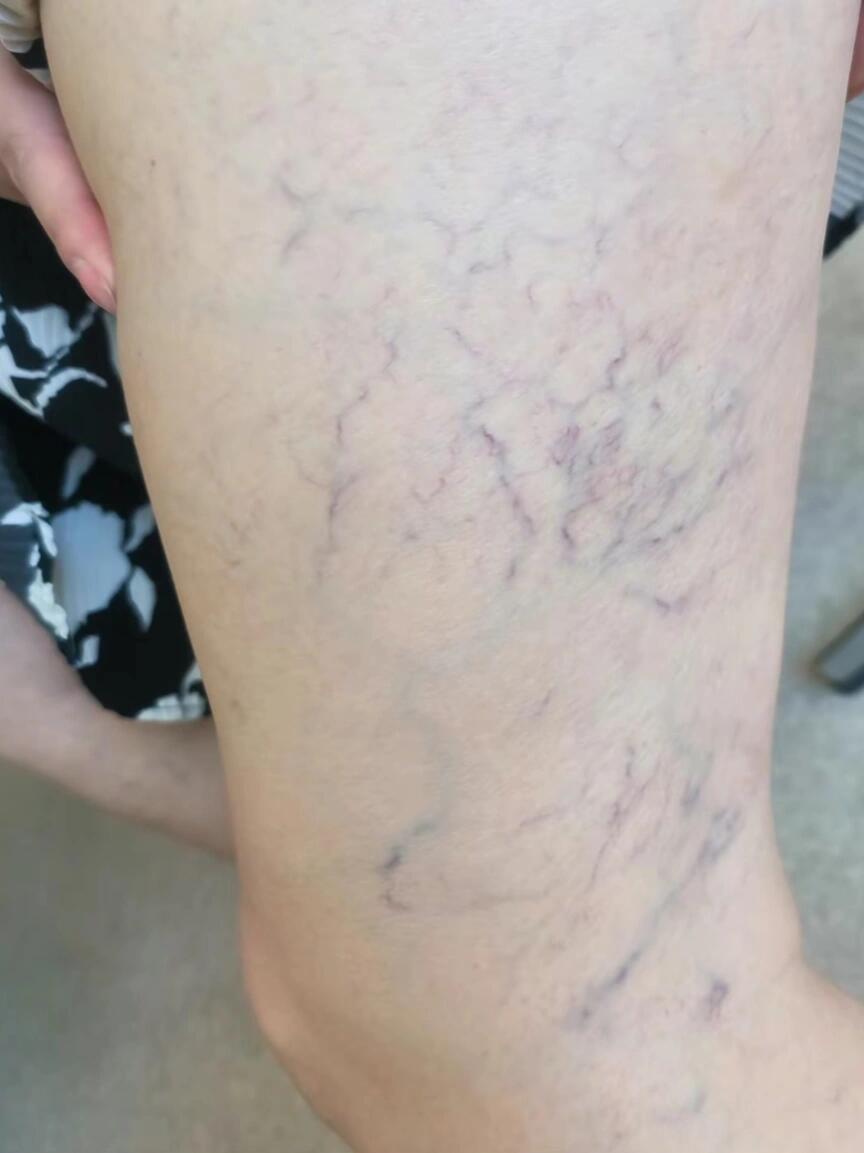 悟了!原来这就是静脉曲张征兆