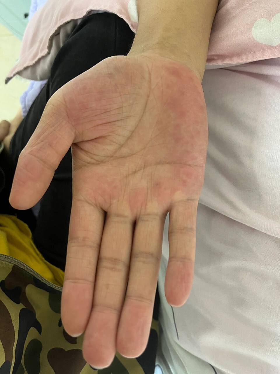 这是肝掌吗? 这是男朋友的手,可以帮忙看看是肝掌吗?