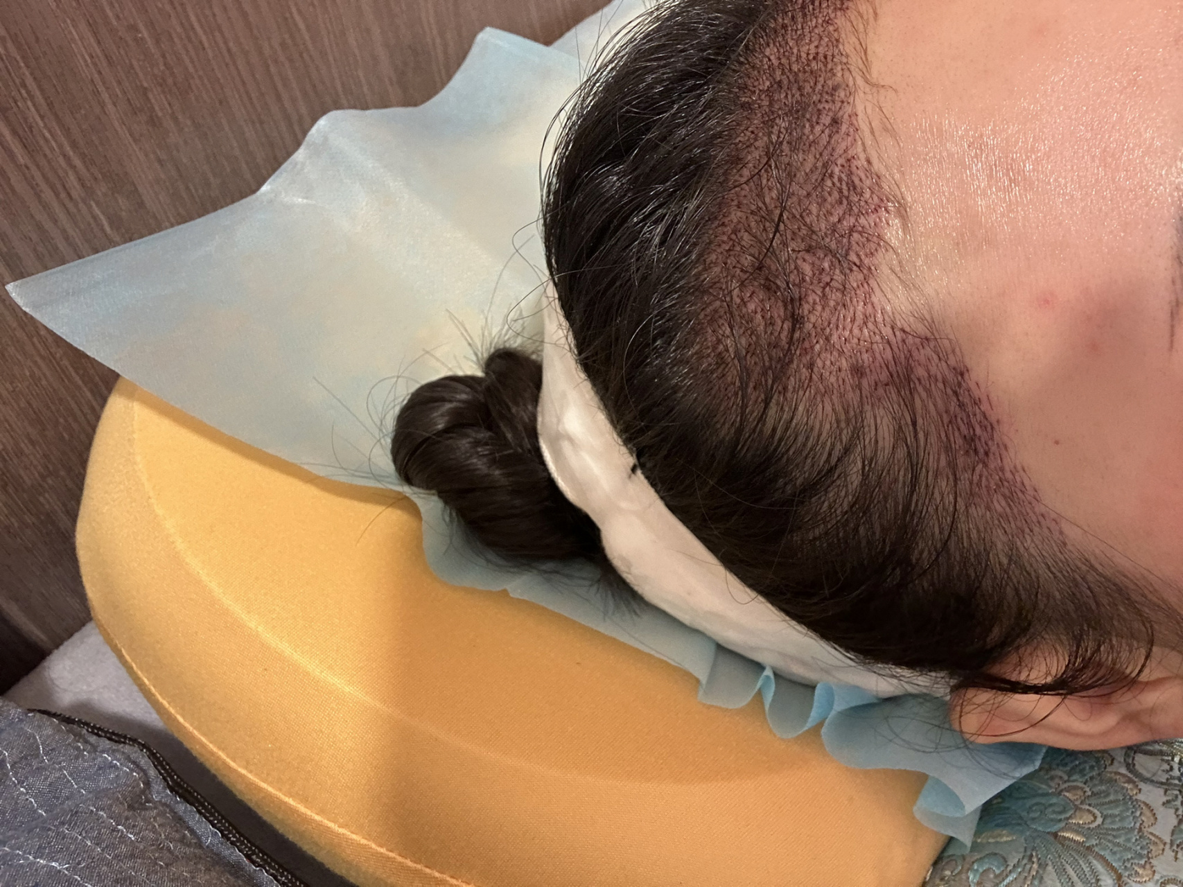 植发全身酸痛(植发后痛得让人受不了)