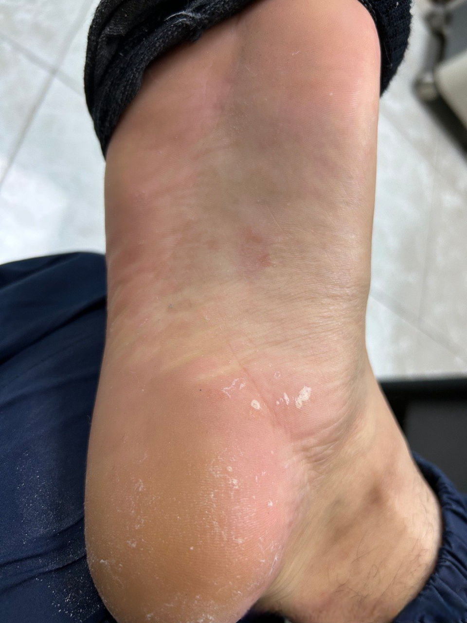 上起过红点,不过两三天就下去了,脚上有脱皮,有点害怕是二期梅毒疹