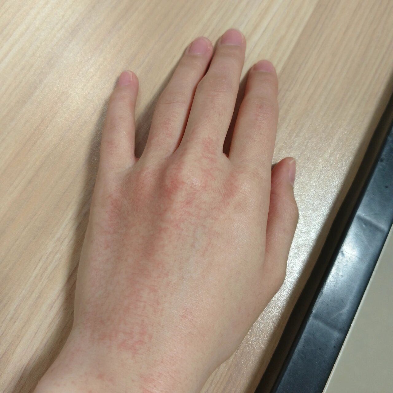 最近太冷了,手伸出去一会儿就冻得不行,洗完热水澡后手背就变成这样