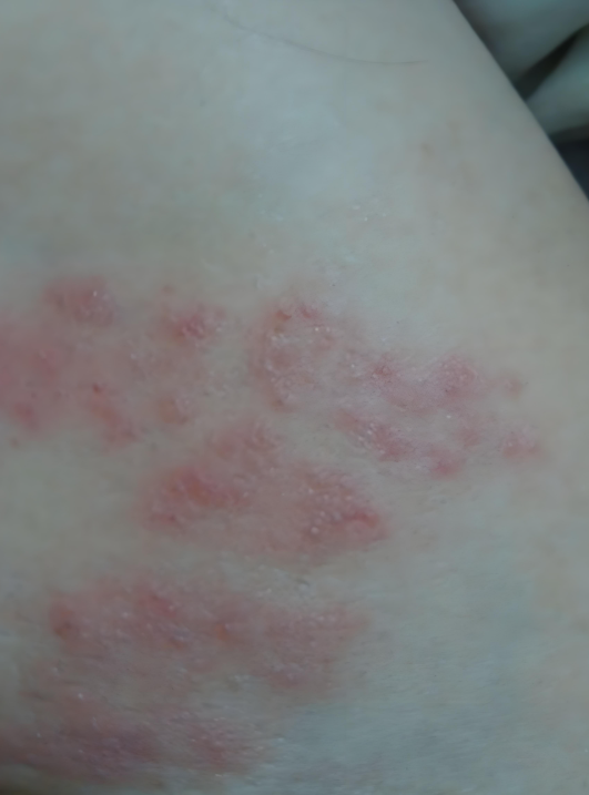 大腿内侧长红疙瘩并且很痒,常见原因有股癣,湿疹和毛囊炎