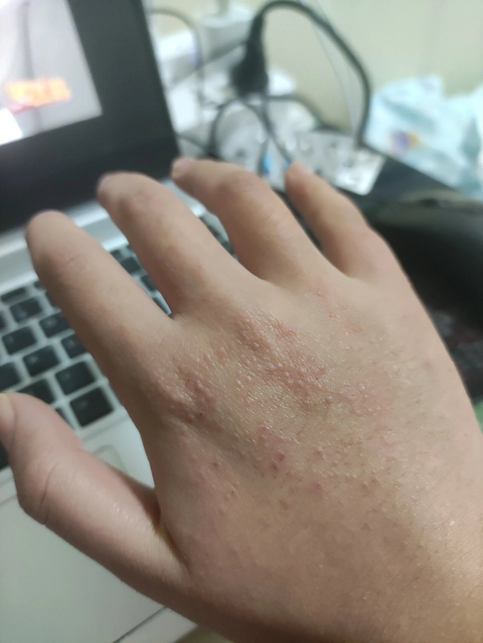 阳了之后手上起疹子……(后续)开始用药了