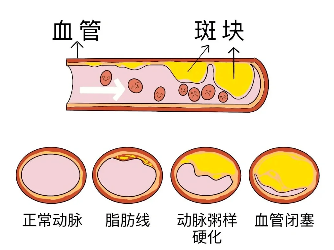公式:动脉硬化指数=(总胆固醇数值-高密度脂蛋白数值)÷高密度脂蛋白