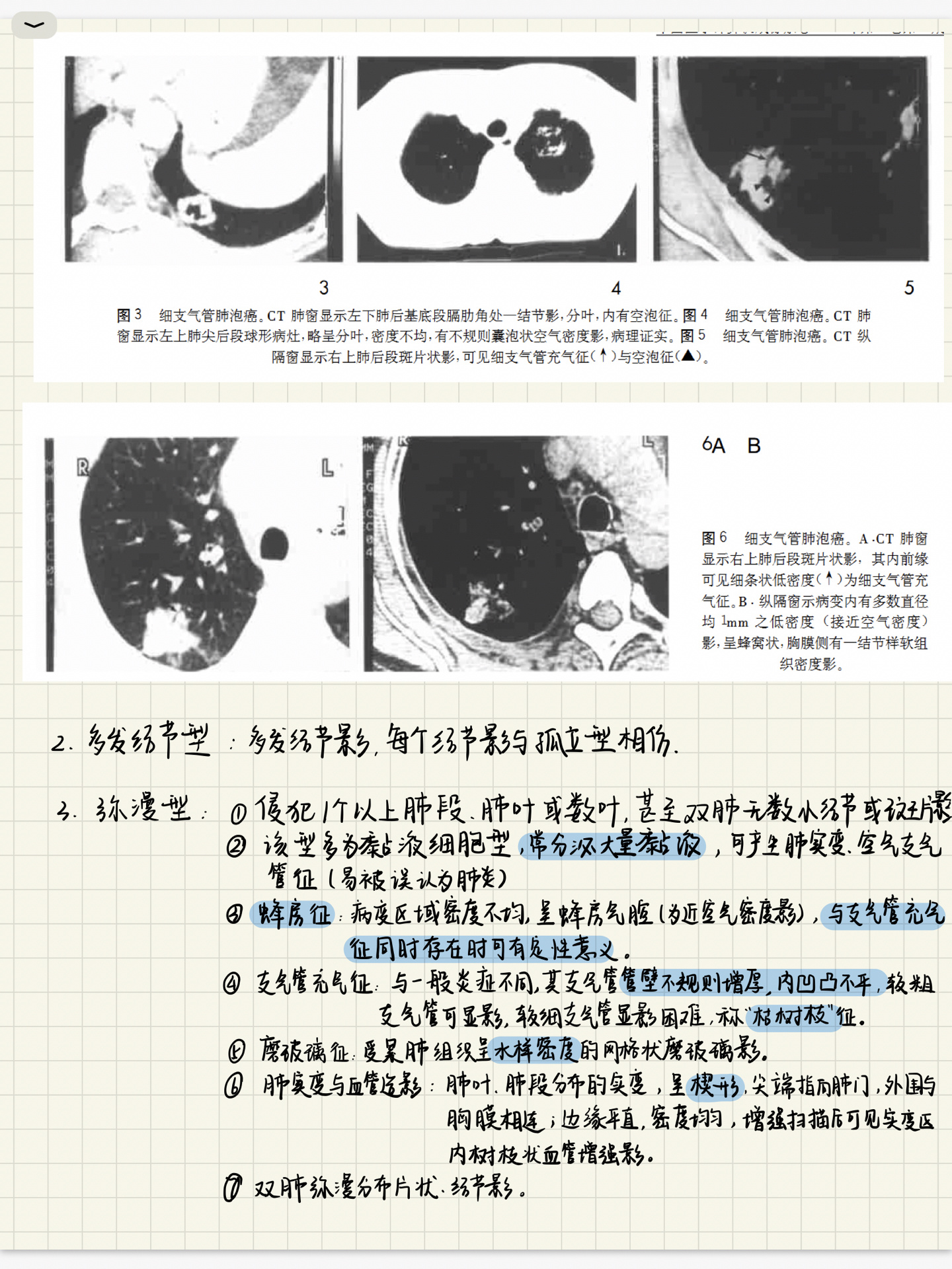 细支气管充气征图片