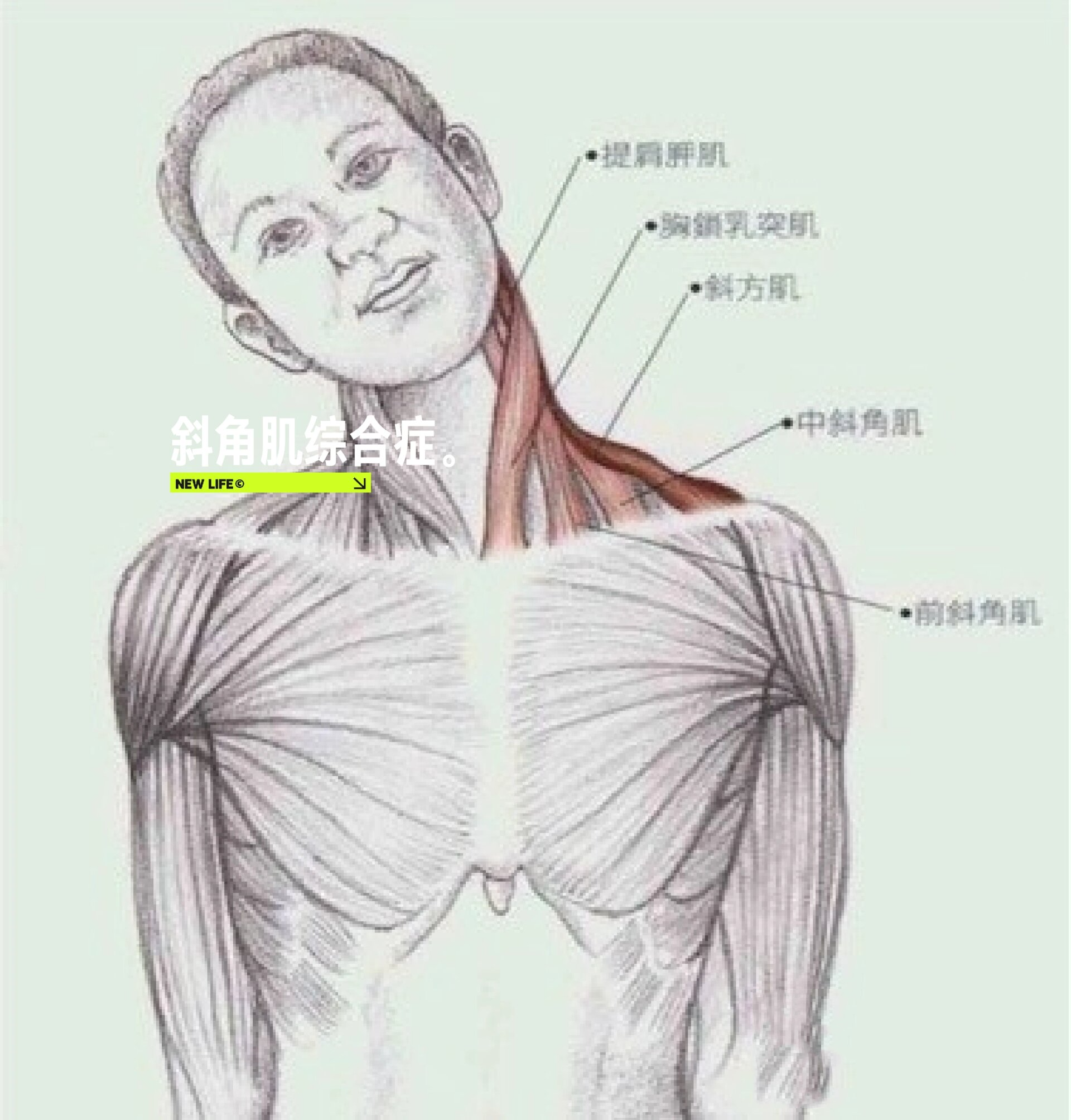 前斜角肌综合症图片