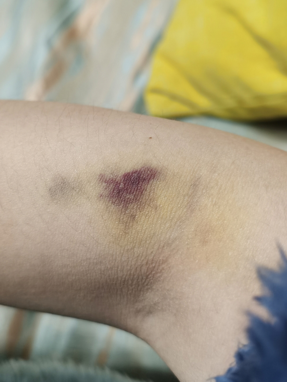 每次抽血都淤青! 因为甲状腺功能减退,就是甲减!