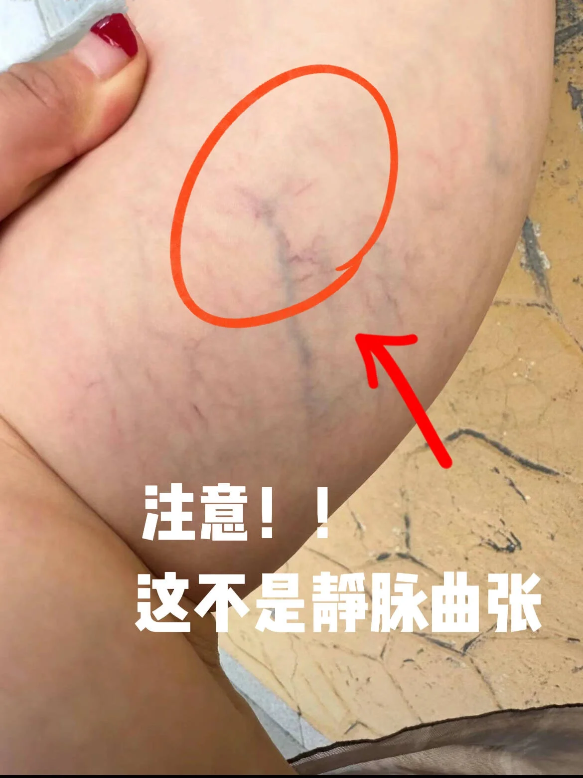 到底还有谁还分不清静脉曲张?