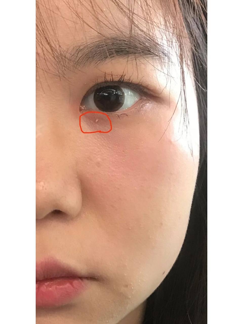 眼下长了个疙瘩家人们 长挺久了抠不掉 这是啥啊