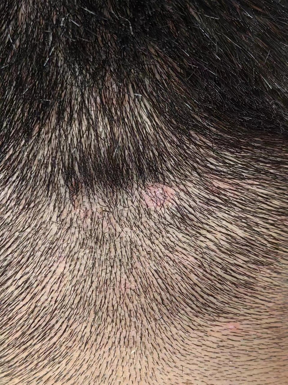 头部肉瘊一次性祛根,不手术,不激光,不冷冻 安全无痛祛除,不伤害毛囊