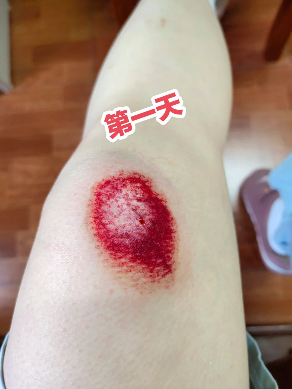 摔伤膝盖伤口结痂化脓了怎么办 第一天:骑电动车摔伤的第一天,感觉