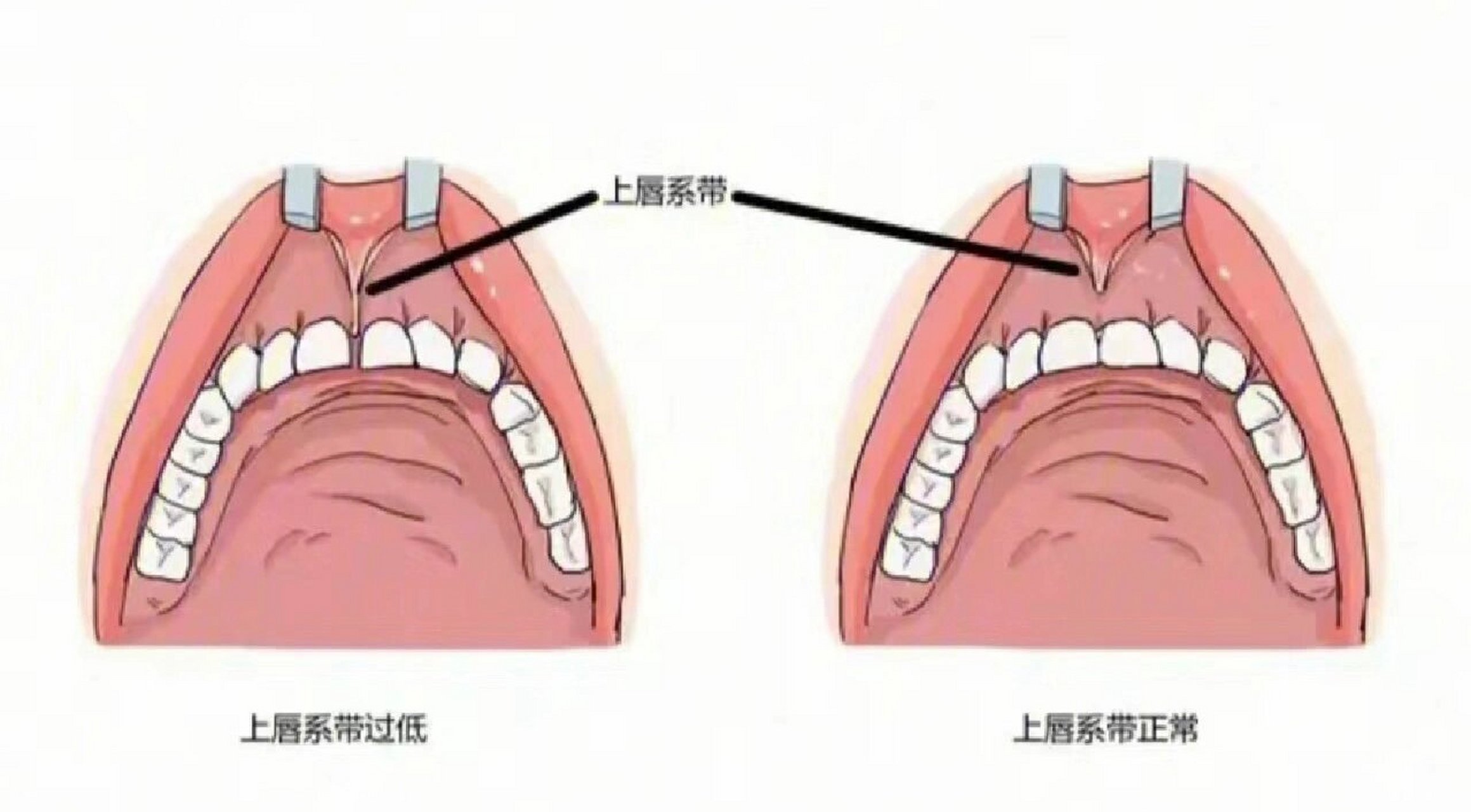 上唇系带断裂图片