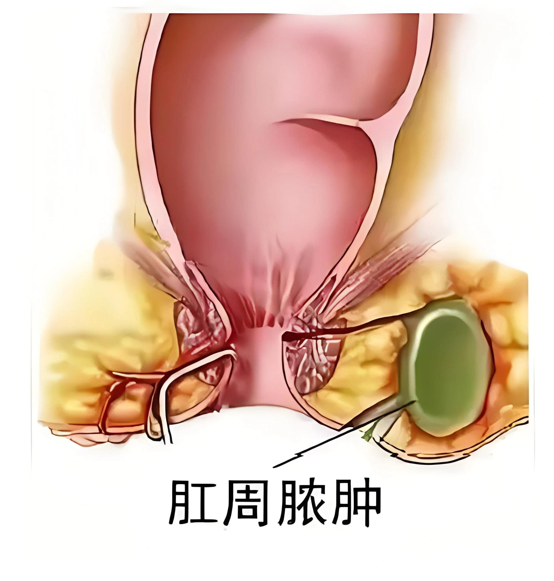 肛痈中医图片