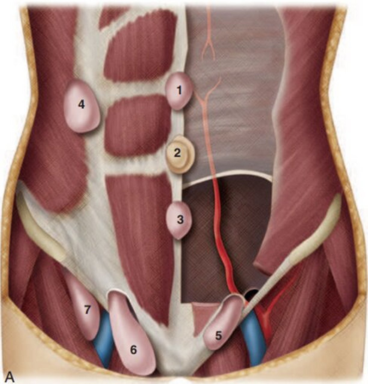 前腹壁腹外疝模式图:102白线疝(上腹疝),202脐疝,02302白线疝