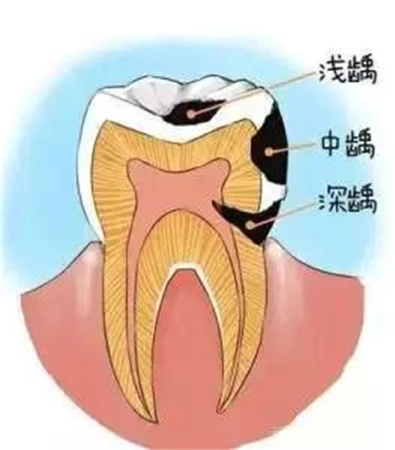 牙齿蛀虫图片卡通图片