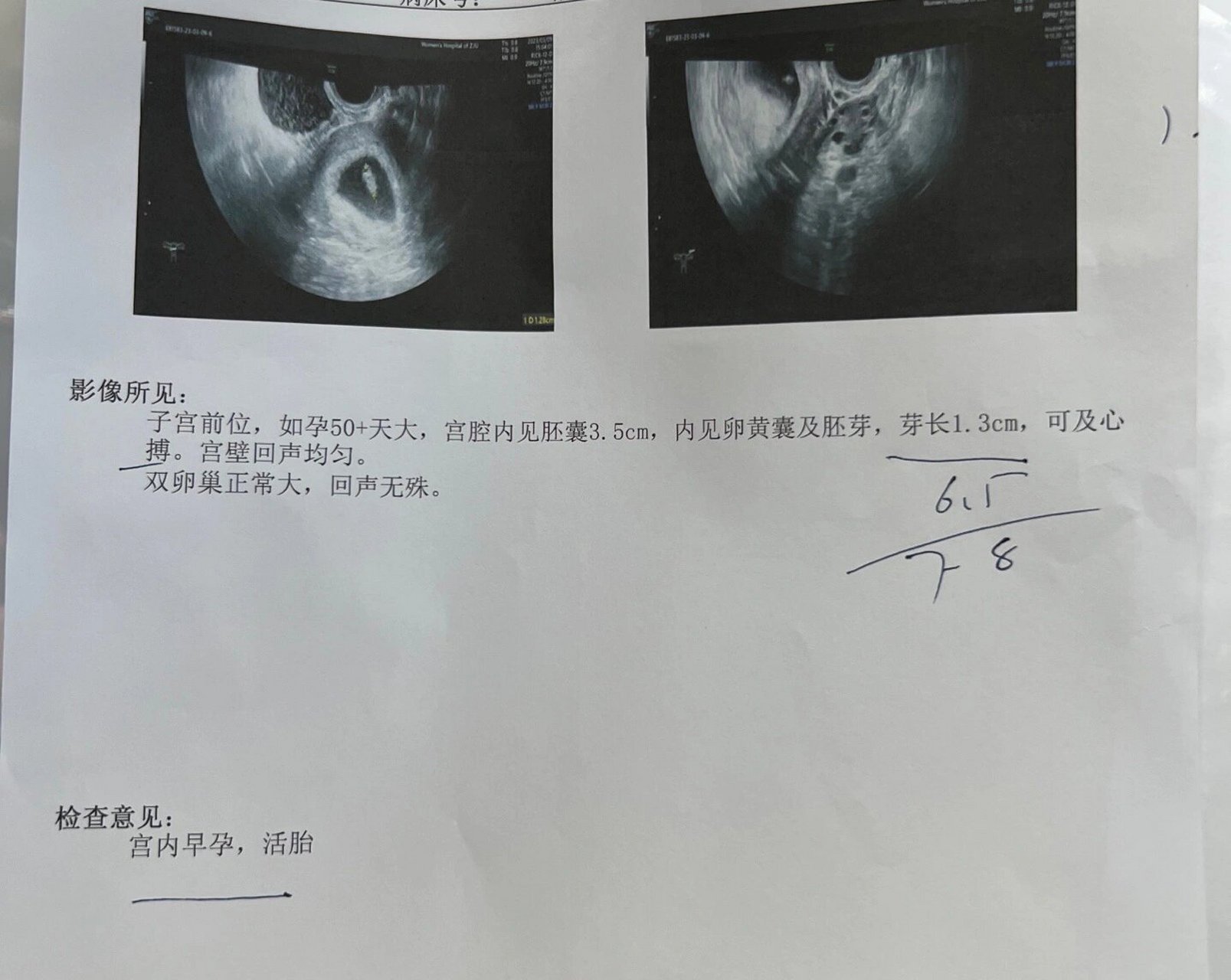 三角形孕囊是男是女 不是说茄98型的是儿子,圆形的是女儿吗?