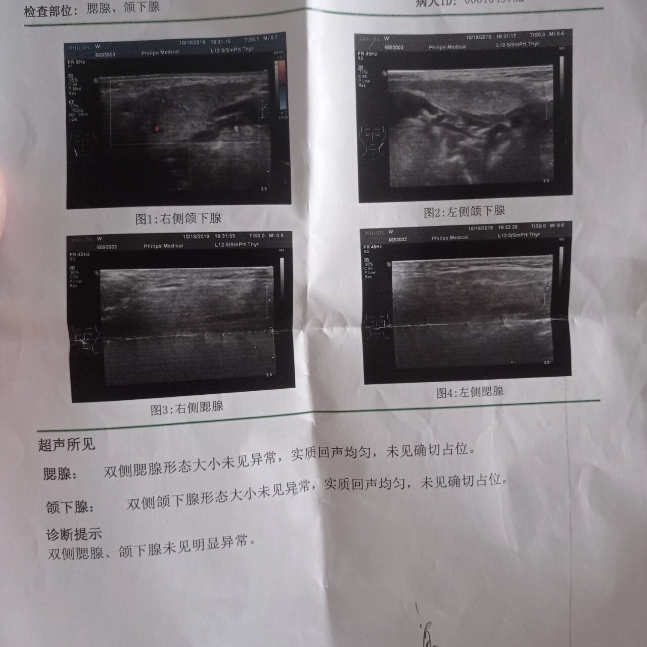 2019年时,我就看过医生,照了腮腺,颌下腺超声检查(图3)并无异常,医生