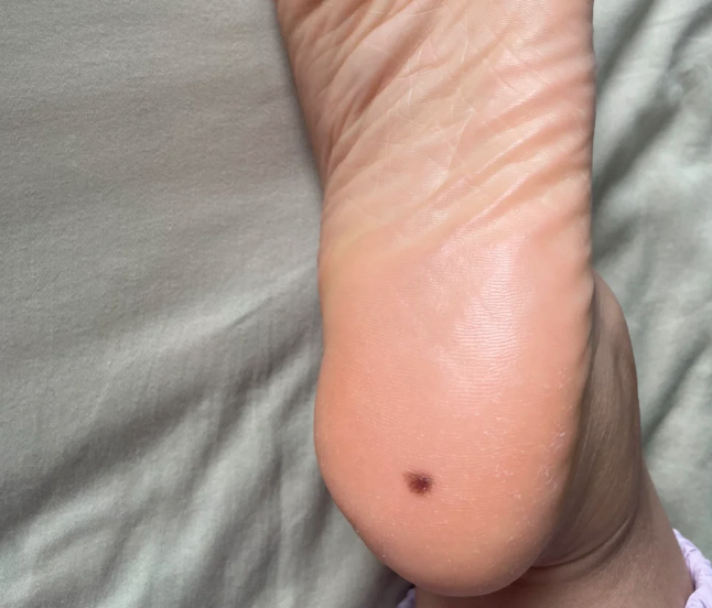 脚底突然出现浅褐色斑块,可能是跖疣,交界痣或黑踵病