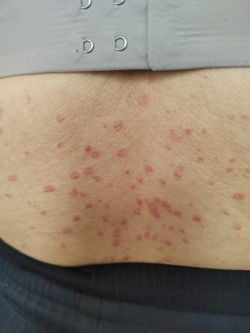 躯干四肢出现的鳞屑性斑块,奥氏征阳性.#银屑病