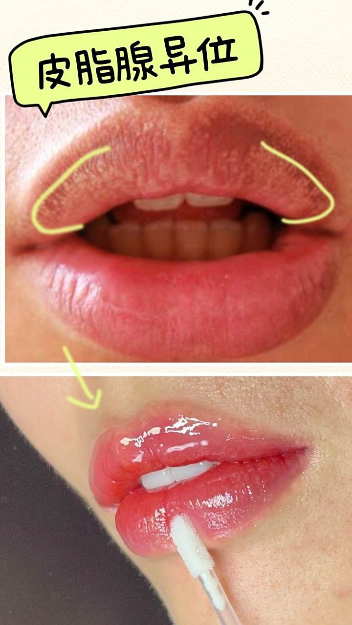 嘴唇有这种小颗粒怎么办?