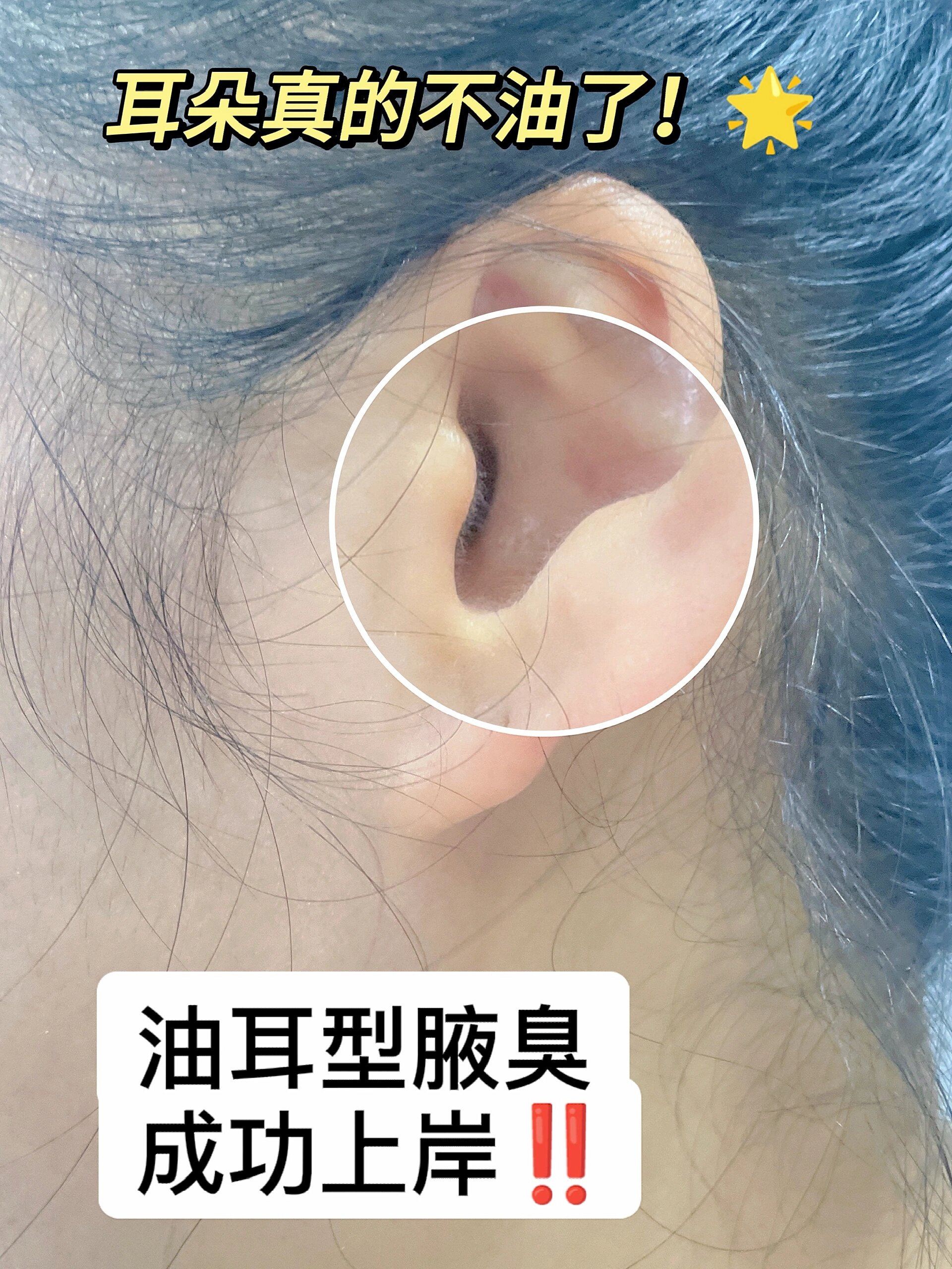 油耳型狐臭成功上岸!顽固异味,轻松搞定